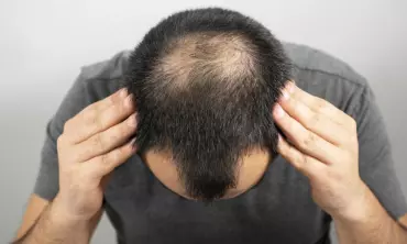 Tips Cara Alami Mengatasi Kebotakan pada Pria