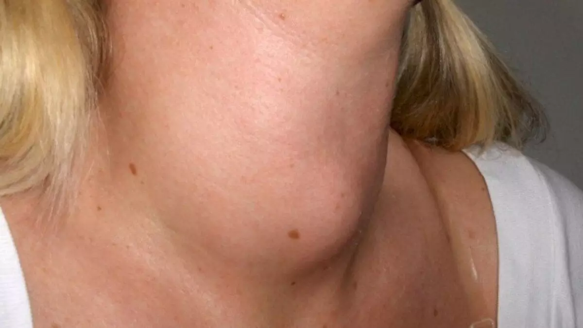 penyakit gondok akibat kekurangan yodium