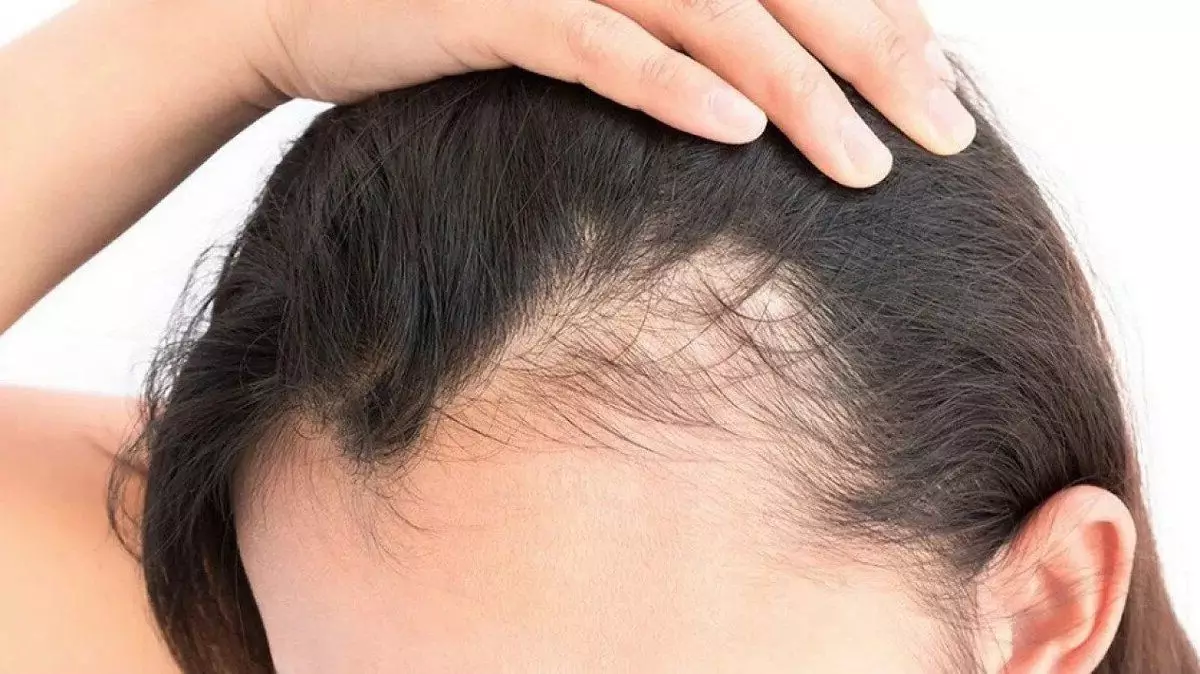 penyebab kerontokan dan kebotakan rambut