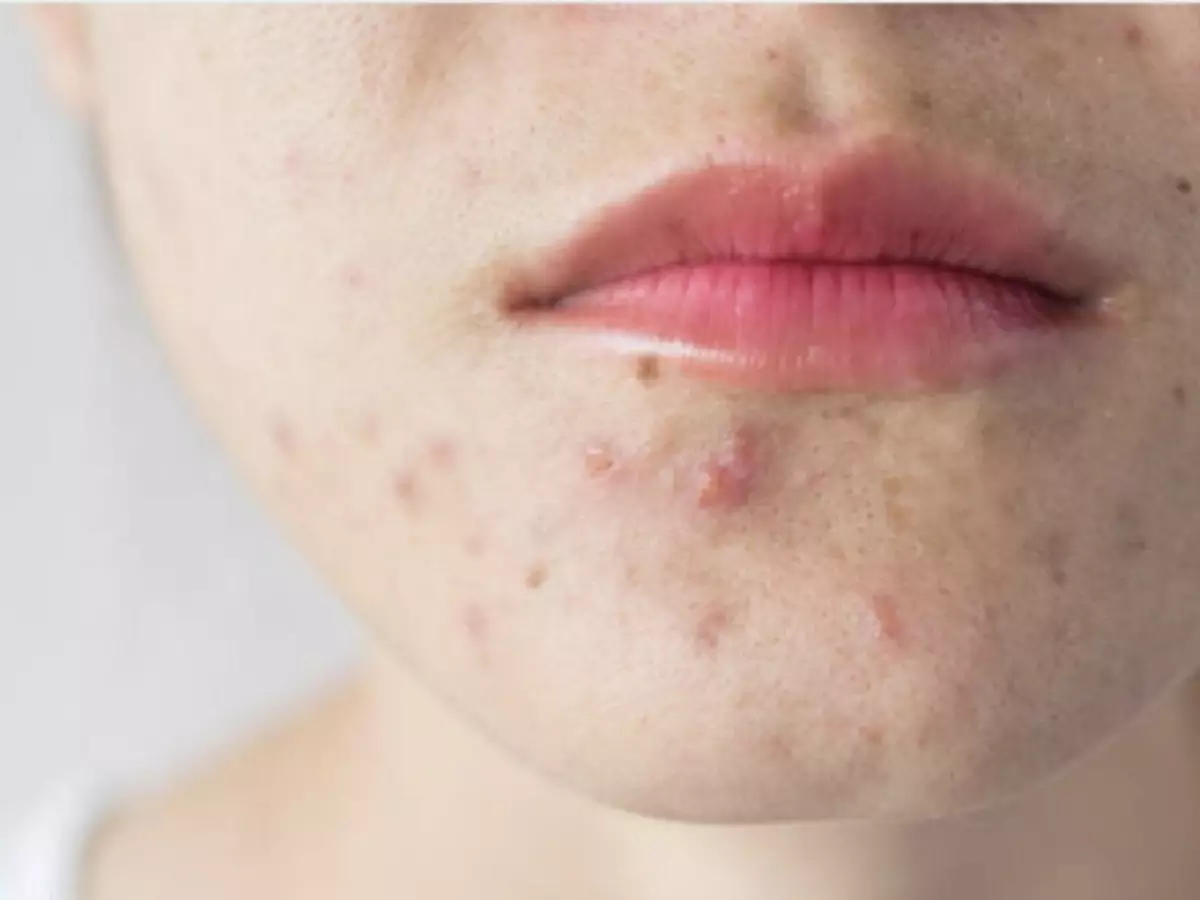 bekas-jerawat-susah-hilang bekas-jerawat-susah-hilang