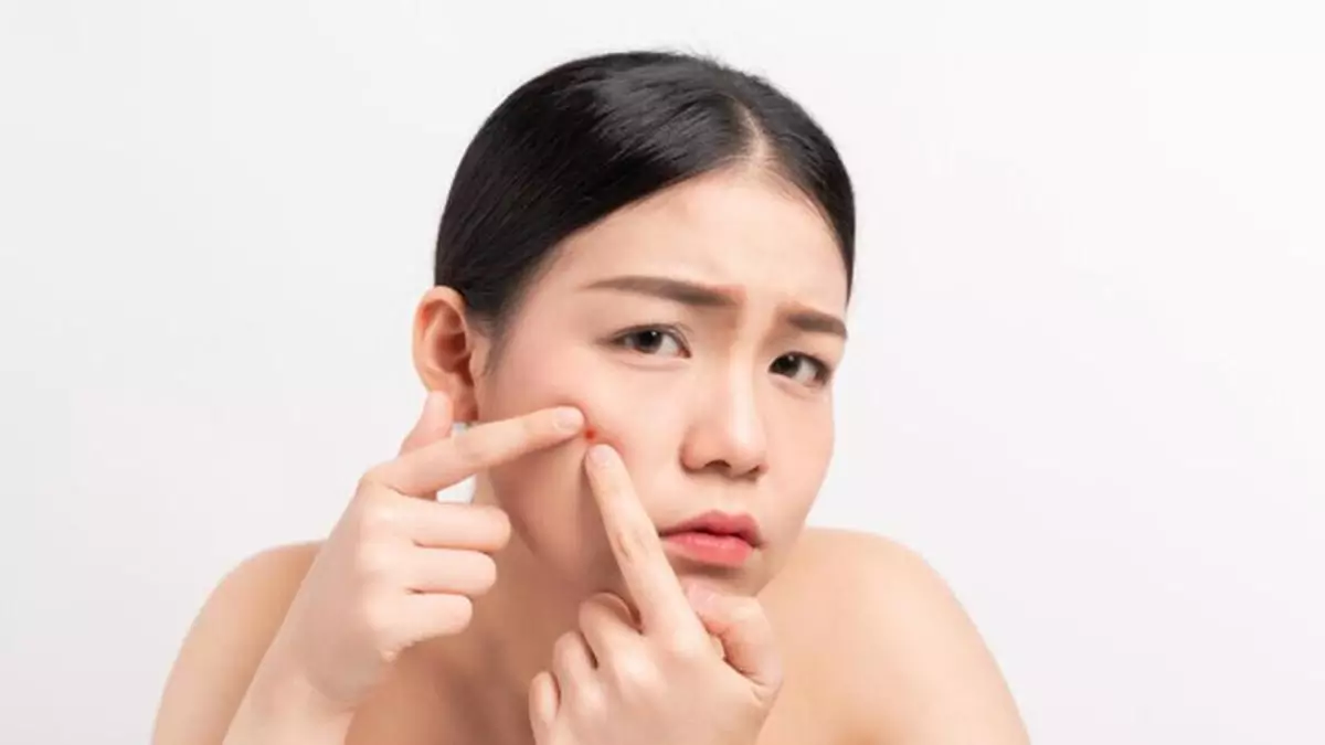 jerawat-hormon jerawat-hormon