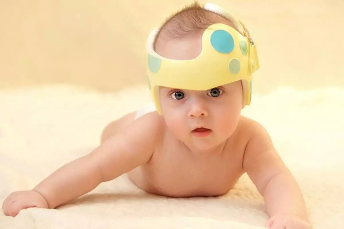gunakan ikat kepal atau helm khusus pada bayi gunakan ikat kepal atau helm khusus pada bayi