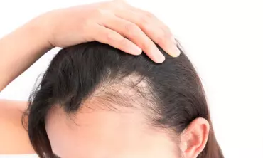 Cara Merawat Rambut agar Sehat dan Tidak Mudah Rontok