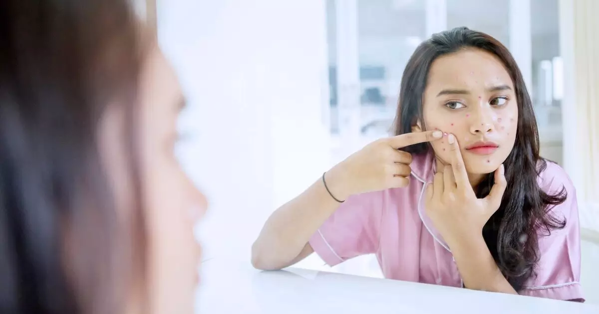 bahan-alami-atasi-jerawat