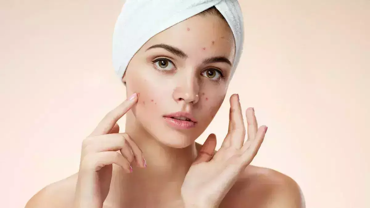 Penyebab jerawat bisa diketahui lewat letaknya