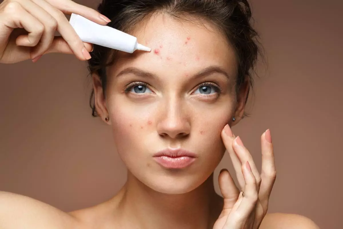 permasalahan jerawat bisa muncul karena beberapa faktor