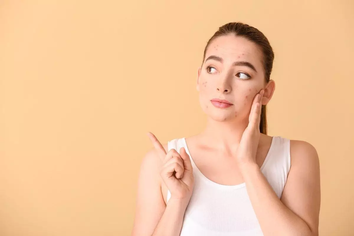 jerawat bisa diatasi dengan beberapa cara