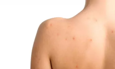 Penyebab Munculnya Jerawat di Badan yang Jarang Disadari