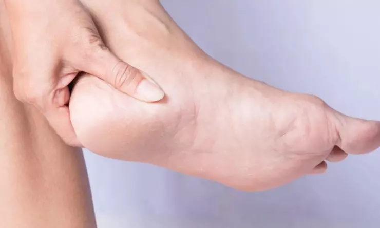 Tips Mengatasi Tumit agar Tidak Pecah-pecah