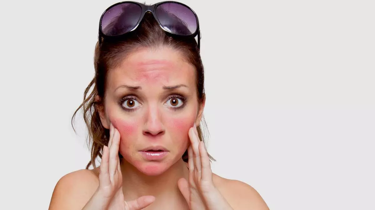 Kulit yang terbakar sinar matahari