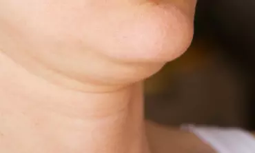 Cara Simpel Hilangkan Double Chin dan Lemak Diwajah