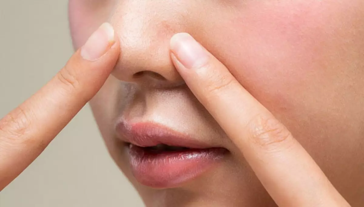 Cara Menghilangkan Komedo Hitam