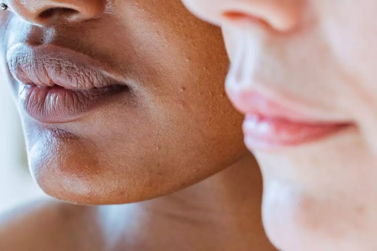 Kulit Berminyak Kulit Berminyak