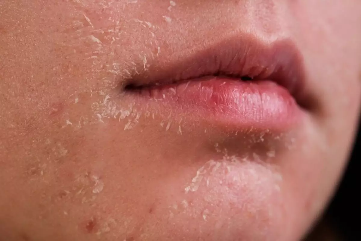 Kulit Kering Kulit Kering