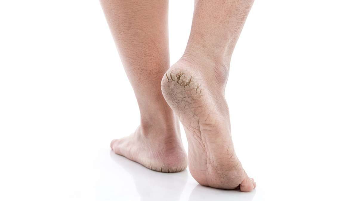 mencegah kulit kaki pecah mencegah kulit kaki pecah