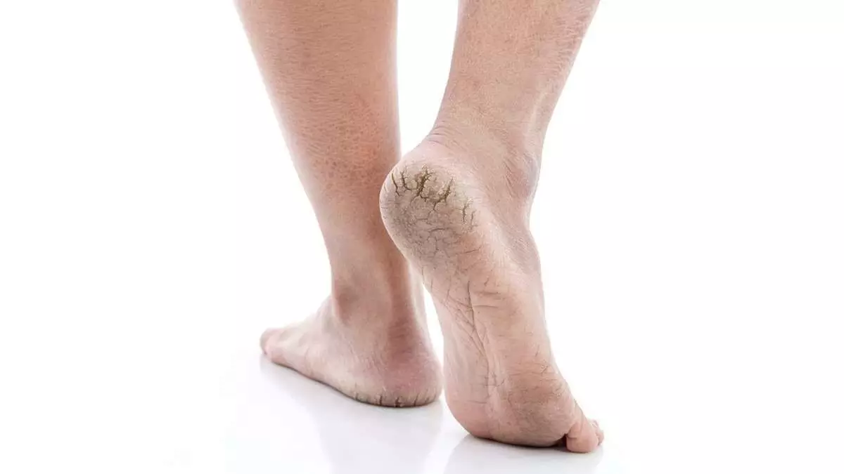 mencegah kulit kaki pecah