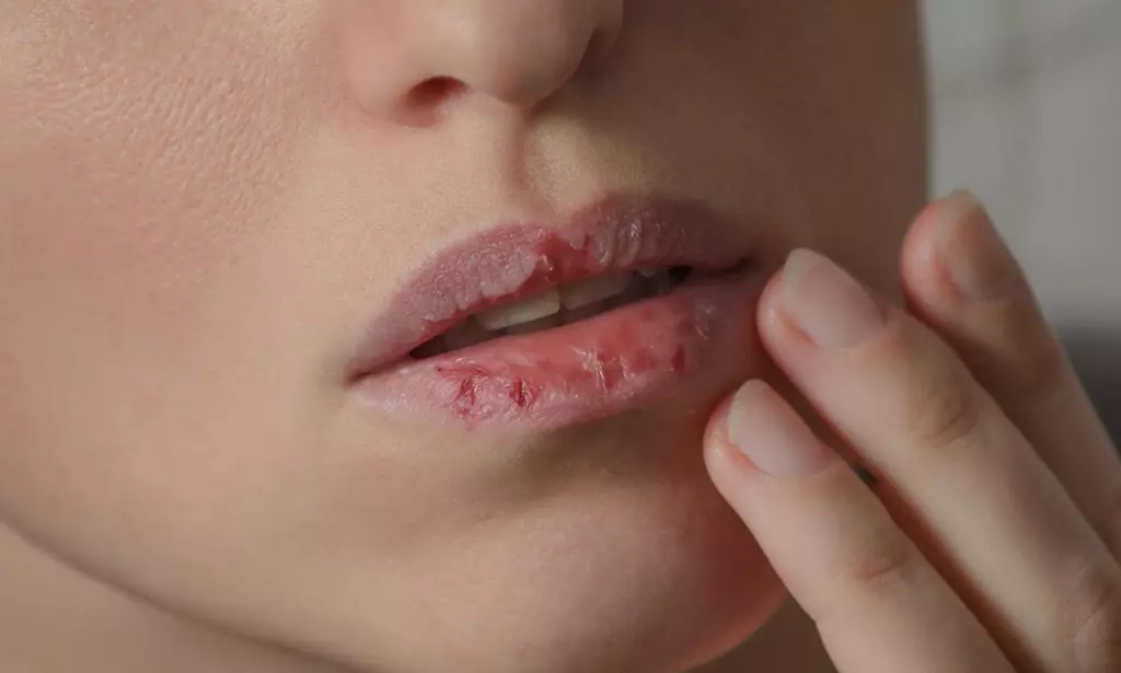 Simak! Cara Mengatasi Bibir Kering Saat Puasa