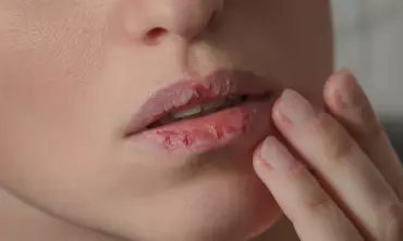 Simak! Cara Mengatasi Bibir Kering Saat Puasa